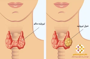 علائم تیروئید کم‌کار و پرکار