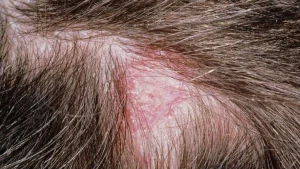 اگزما پوست سر کودکان:راهکار های پیشگیری و درمان