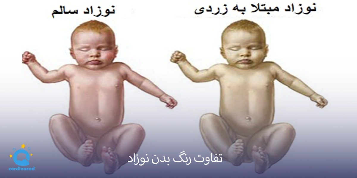 زردی نوزاد خطرناک است