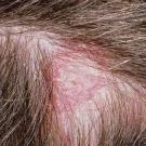 اگزما پوست سر کودکان:راهکار های پیشگیری و درمان