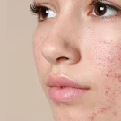 روتین پوستی پوست چرب : نکات کاربردی