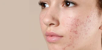 روتین پوستی پوست چرب : نکات کاربردی