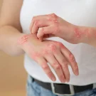 درمان اگزما